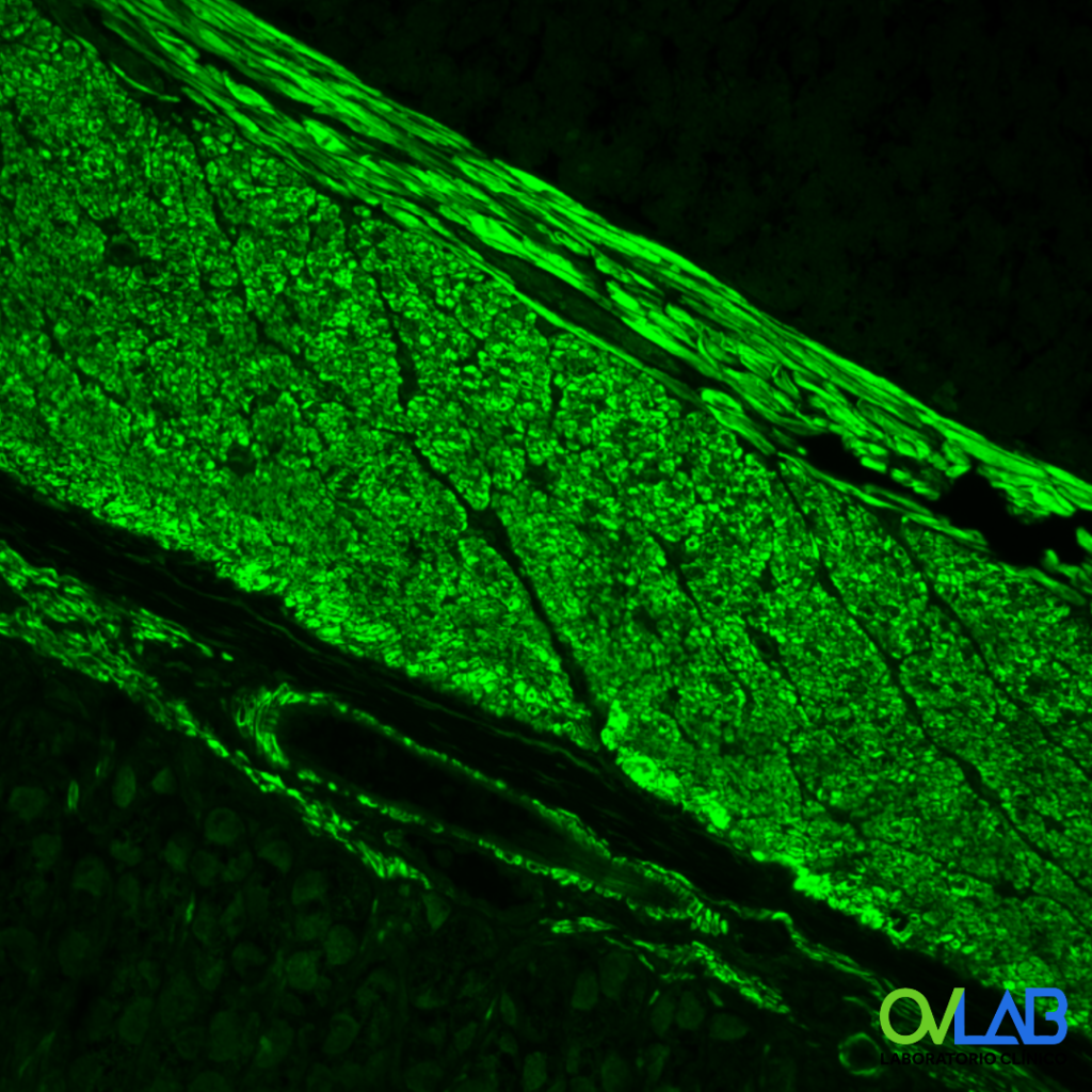 EPSTEIN BARR VIRUS (VCA, IgG) OVLAB O&V Laboratorios